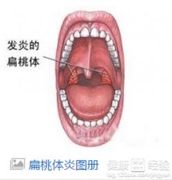 扁桃体发炎吃哈密瓜,天然食疗的神奇疗效